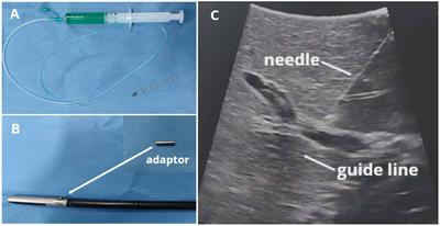 A novel method of ultrasound-guided positive staining using indocyanine green fluorescence in laparoscopic anatomical liver resection of segments VII and VIII